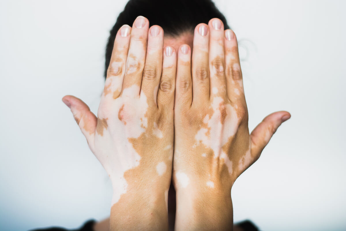 Vitiligo a kéz felületén